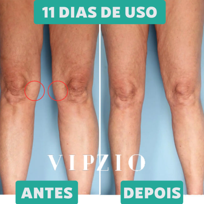 ARTICure - Terapia Ortopédica para Joelho 4em1